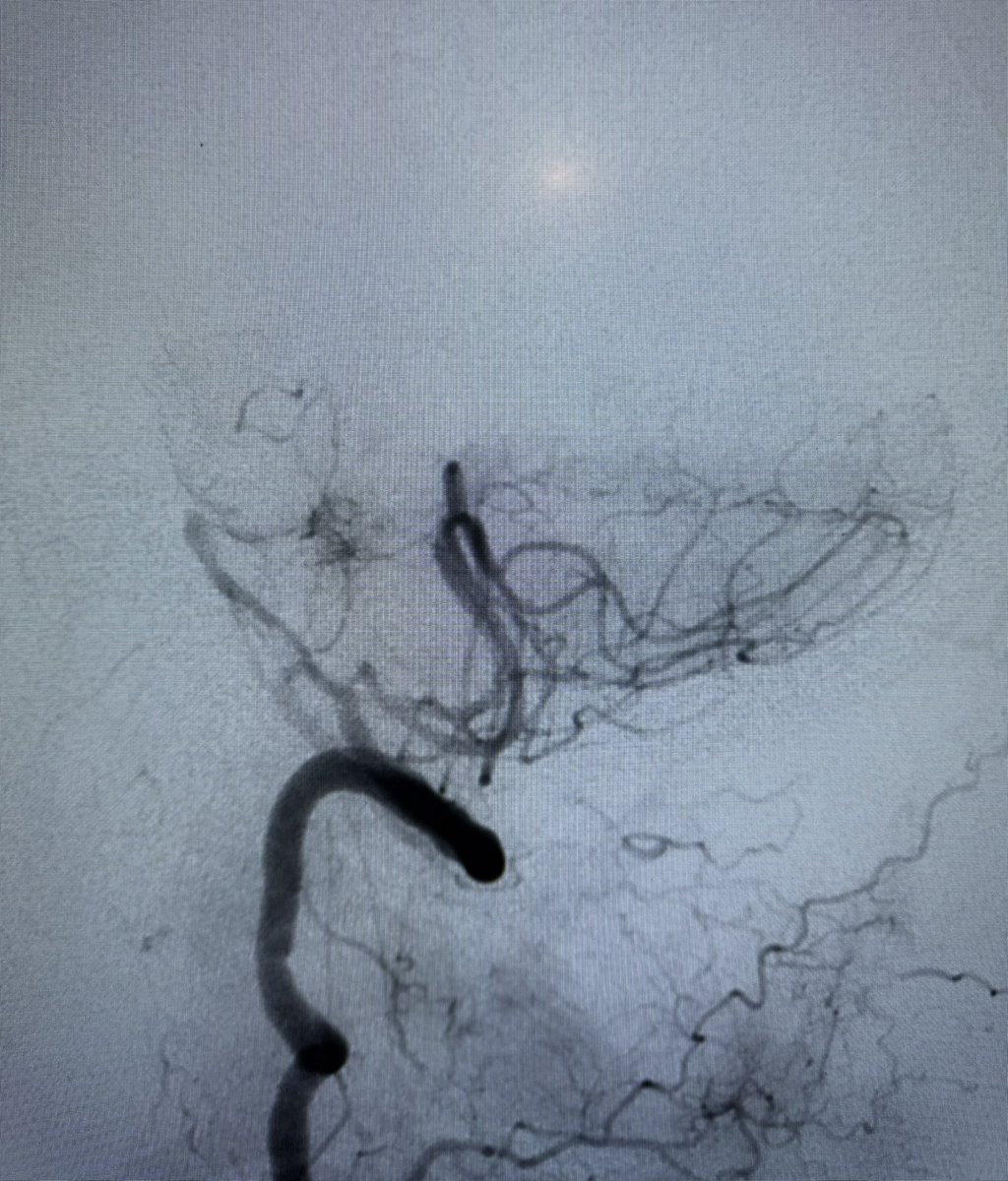 NaderElSeblani's tweet photo. 🚨 Basilar stroke with life-saving thrombectomy!
LKW 4 hrs
Trevo stent retriever captured large plaque burden — achieved TICI 3 reperfusion 🧠💥
Patient recovered with only mild right arm weakness.
Time is brain — and flow is life! 💪
#Stroke 
#NeuroEndovascularSurgery #SVIN https://t.co/WnqPzKSGcu