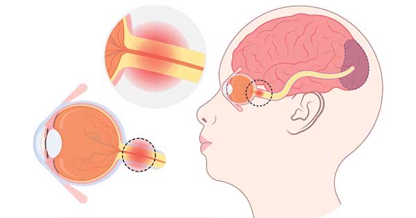 Ayala30Juliana's tweet photo. 🧵¡La neuritis óptica no siempre es esclerosis múltiple!
#rotreuma @carvicab 
¿Sabías que existen varias causas autoinmunes que pueden inflamar el nervio óptico y causar pérdida de visión?
Te cuento lo que dice la ciencia 👇 https://t.co/mlSUAgTEPk
