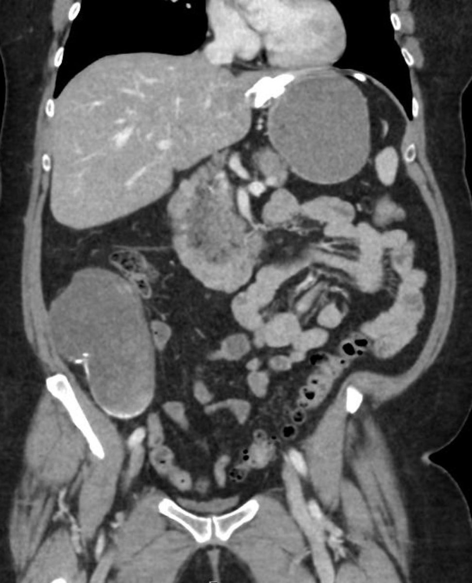 <a href="/CasesCookyJar/">Cases From the Cooky Jar</a> <a href="/cookyscan1/">Cooky Menias</a> <a href="/RadioGraphics/">RadioGraphics</a> Companion case! 😊