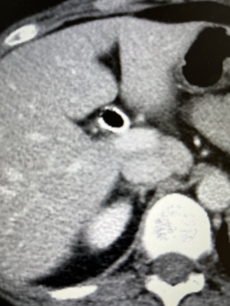 PNEUMOBILIA: Also known as aerobilia, is the accumulation of gas in the biliary tree. Important to distinguish pneumobilia from portal venous gas. There are many causes of pneumobilia and clinical context is often important. Etiology: Biliary stent