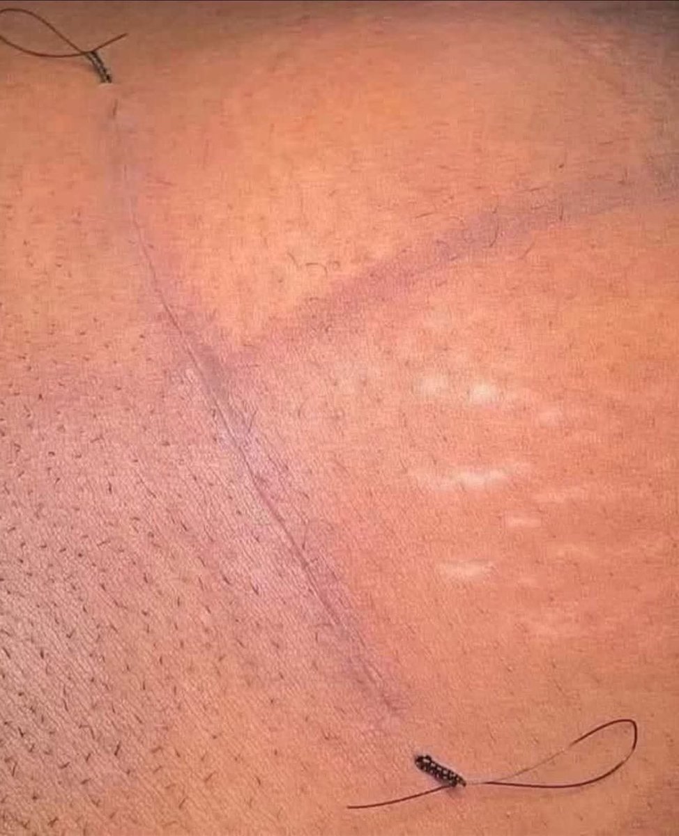 Dear Doctors in Ghana,

We appreciate all you do for us, however we have one more request... When our wives come to you for CS, can you try and close them up neatly like this for us? We know you can do it if you really want to. You guys have gifted hands, so please try for us.