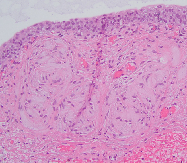 URMC Case of the Month
58-year-old male, history of BPH and prostate adenocarcinoma, treated with high dose rate brachytherapy twice. Presented with recurrent microhematuria. Your diagnosis?
#pathology #pathsocial #pathCOM #digpath <a href="/VeronicaUlici/">veronica ulici</a> 
urmc.rochester.edu/pathology-labs…