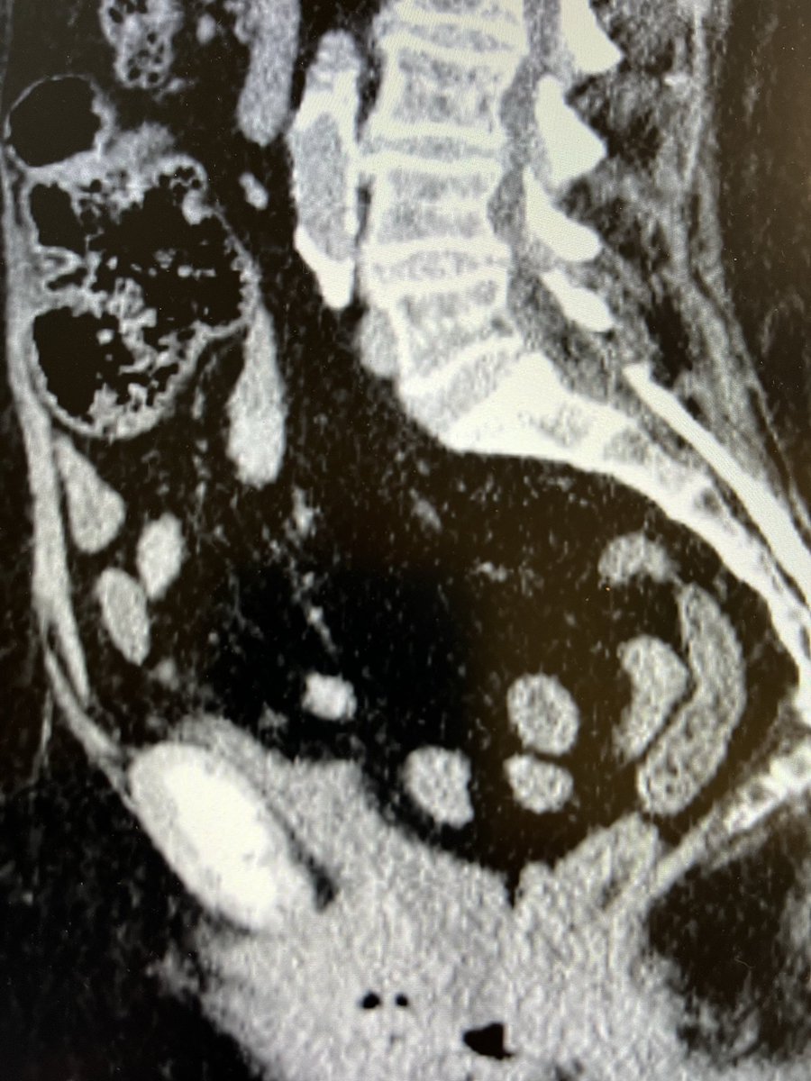 Anterior compartment pelvic floor dysfunction primarily involves weakness in the structures that support the bladder, leading to conditions like cystocele (bladder prolapse) and stress urinary incontinence.
