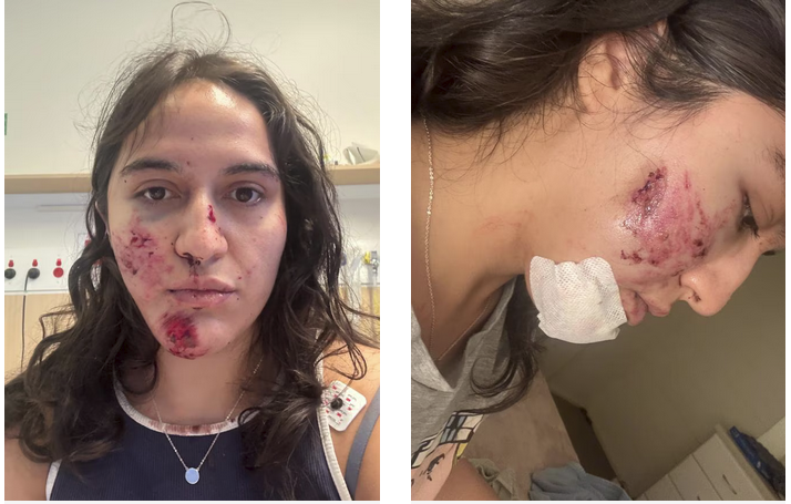 TreeProblemsNSW's tweet image. A territorial magpie swooped down and knocked Ms. Montalva off her bike, striking her face on the concrete, causing multiple fractures on her left cheekbone,  a fracture of the hyoid bone, and extensive blood loss.  Doctors said she is lucky to be alive.
news.com.au/travel/travel-…