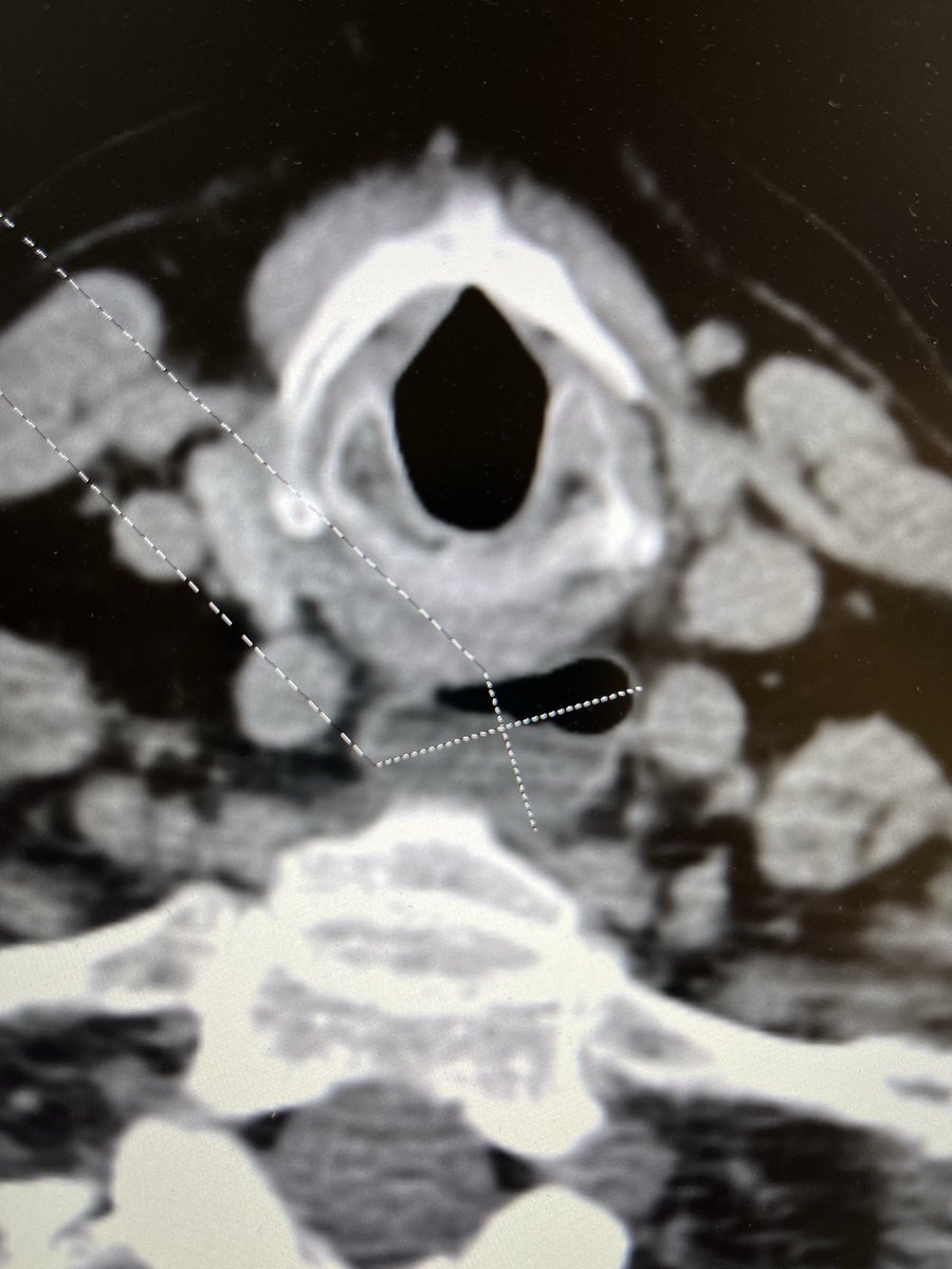 ZENKER DIVERTICULUM: Also known as a pharyngeal pouch, is a posterior outpouching of the hypopharynx, just proximal to the upper esophageal sphincter through a weakness in the muscle layer called the Killian dehiscence.