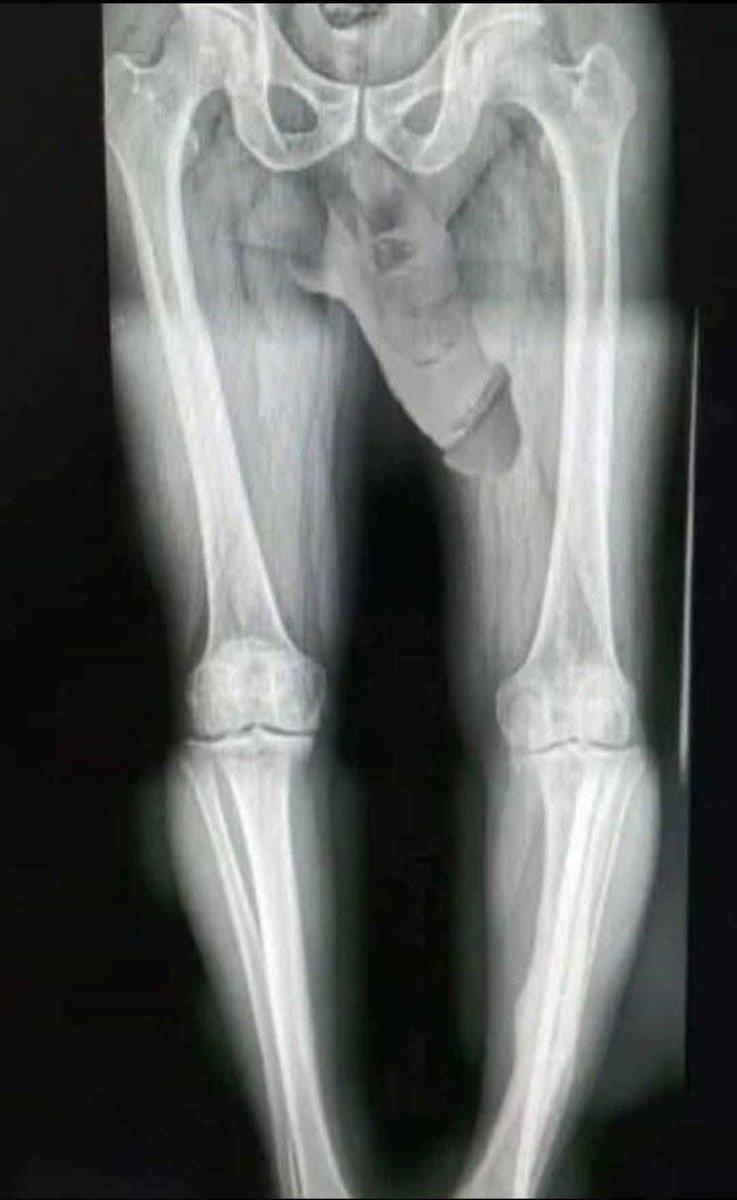 ทำงานหนักไปหน่อยเเล้วปวดขา ก็เลยไปหาหมอ แต่ผลตรวรออกมาปกติดีทุกอย่าง #หำแข็งดีเหมือนเดิม 😂😂