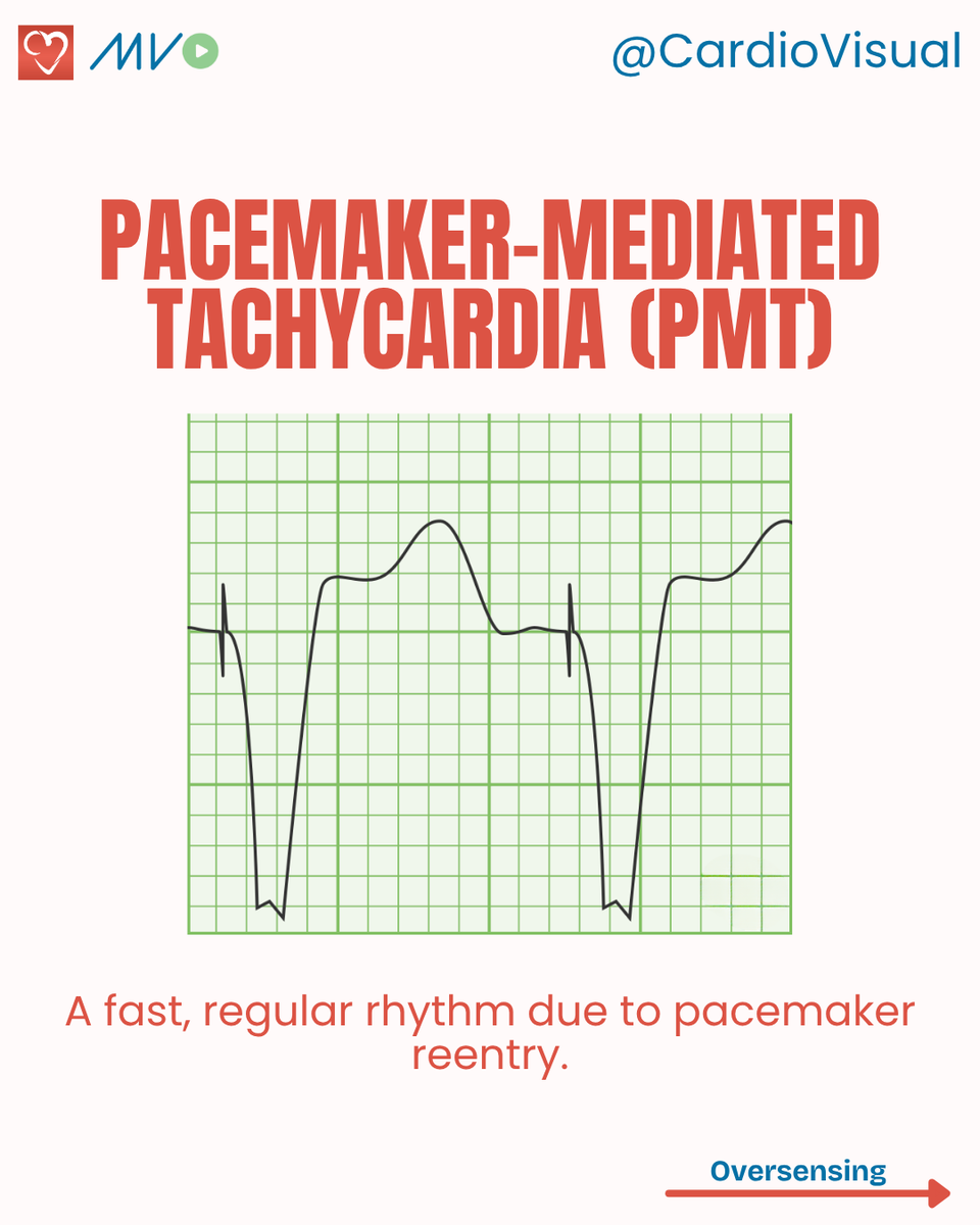 CardioVisualApp's tweet image. Few pacemaker Malfunctions on ECG
Access our video series on how pacemakers and devices are implanted here: heart.medicalvisual.com/learningtracks…
#Pacemaker #ECG #Cardiology #HeartRhythm #Electrophysiology #CardioVisual