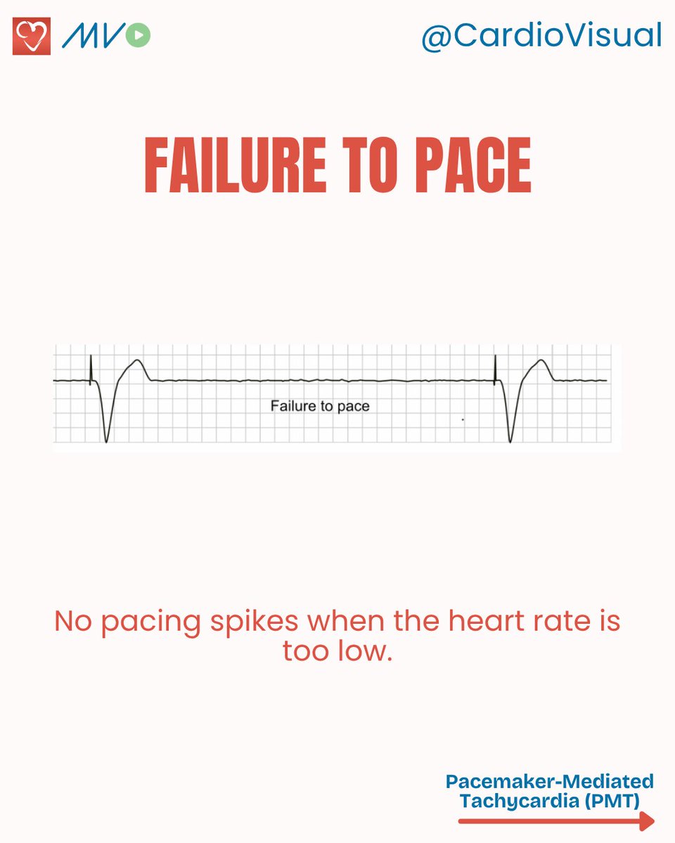CardioVisualApp's tweet image. Few pacemaker Malfunctions on ECG
Access our video series on how pacemakers and devices are implanted here: heart.medicalvisual.com/learningtracks…
#Pacemaker #ECG #Cardiology #HeartRhythm #Electrophysiology #CardioVisual