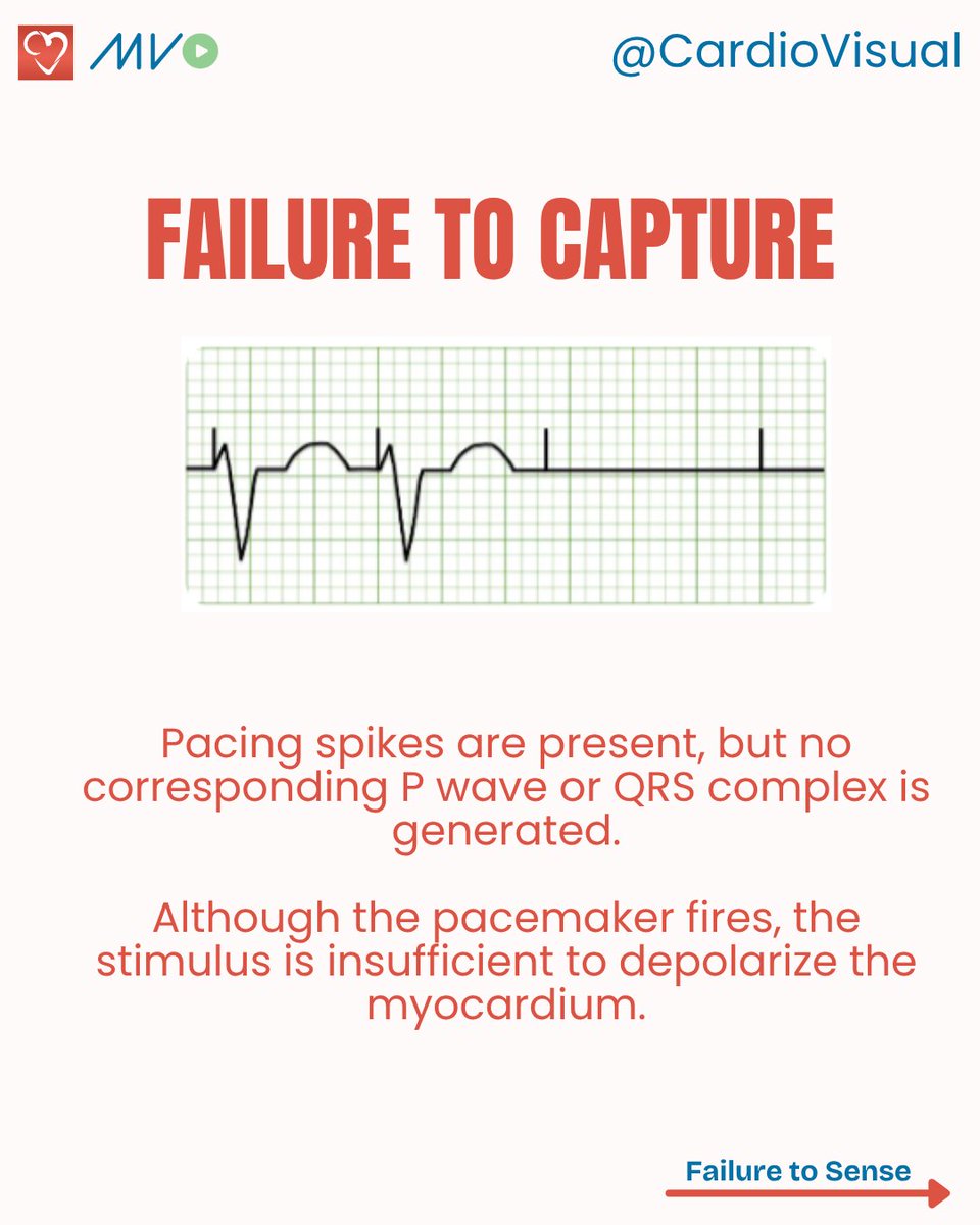 CardioVisualApp's tweet image. Few pacemaker Malfunctions on ECG
Access our video series on how pacemakers and devices are implanted here: heart.medicalvisual.com/learningtracks…
#Pacemaker #ECG #Cardiology #HeartRhythm #Electrophysiology #CardioVisual