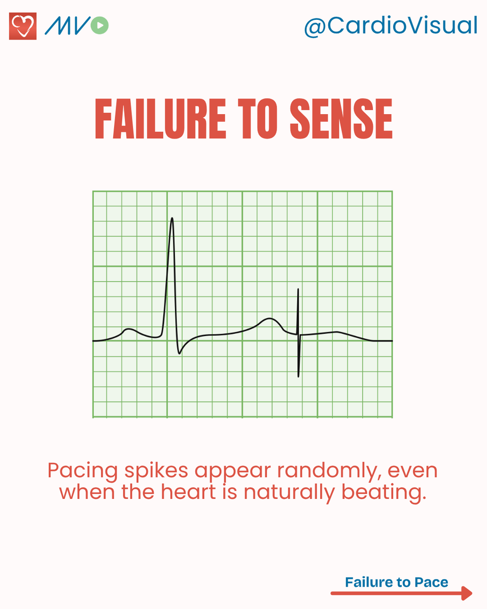 CardioVisualApp's tweet image. Few pacemaker Malfunctions on ECG
Access our video series on how pacemakers and devices are implanted here: heart.medicalvisual.com/learningtracks…
#Pacemaker #ECG #Cardiology #HeartRhythm #Electrophysiology #CardioVisual