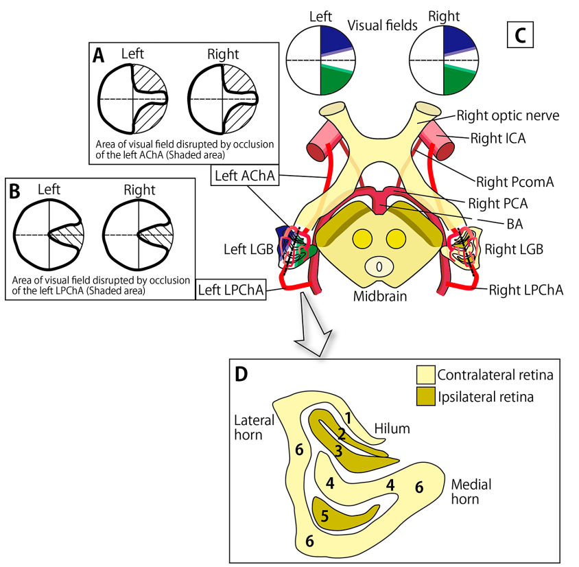 piandro3142's tweet photo. Lesions of the lateral geniculate nucleus, e.g. infarcts of anterior choroidal a. or lateral choroidal a., cause bizarre visual field deficits - homonymous sectoranopia.

The anatomy is confusing - these are the best diagrams I have found to understand it! https://t.co/OYB2J012O6