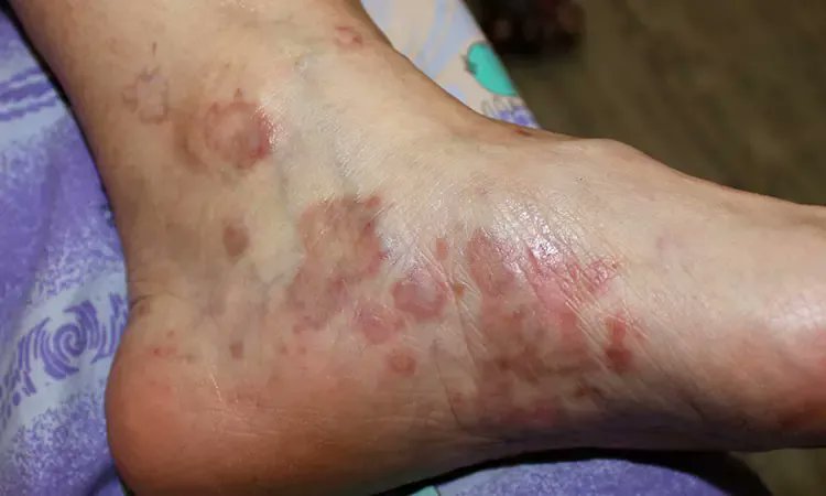 DevidSamith's tweet image. Lichen Planus Symptoms, Causes, Diagnosis and Treatment
natural-health-news.com/lichen-planus-…
#AEWDynamite
#vJazz
#Maxey
#vDillonBrooks
#AnthonyEdwards
#Mavs
#Clippers
#CooperFlagg
#QueenRadio
#Wemb