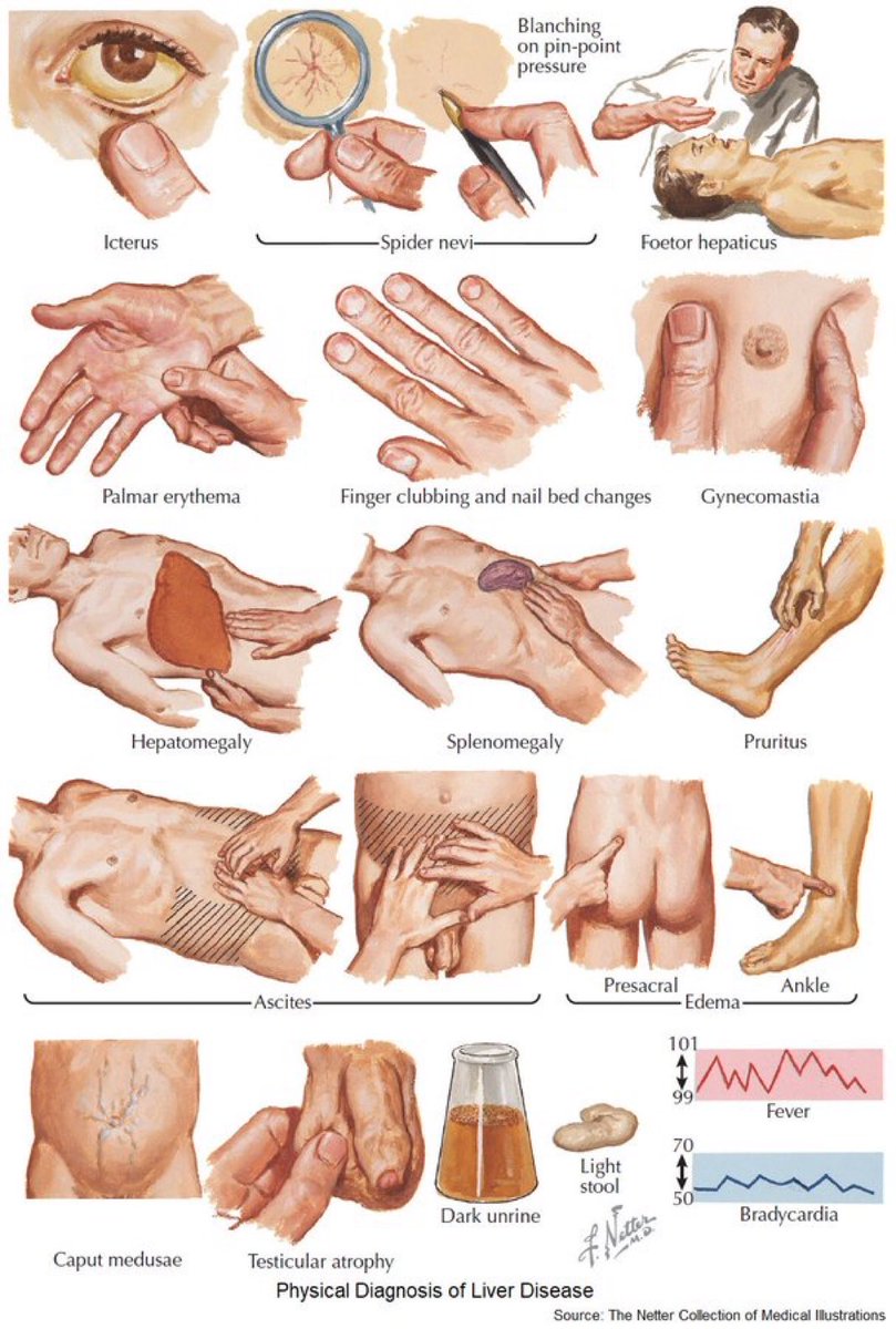InterestingSTEM's tweet photo. Physical Diagnosis of Liver Disease https://t.co/lxktkHJVd3