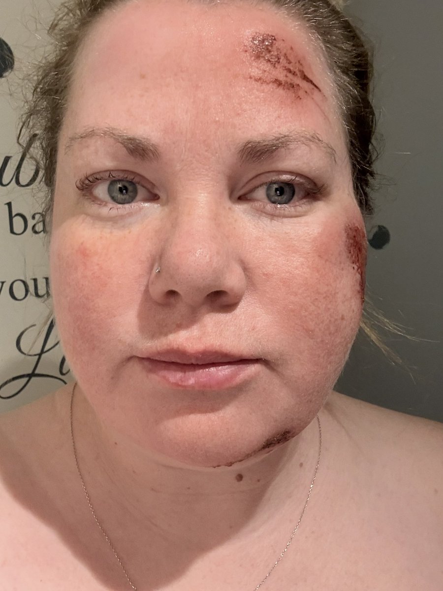graziacarlos's tweet photo. I broke my jaw having a seizure and im ok a liquid diet for EIGHT weeks…..
Im so over soup so @huel has LITERALLY saved the day, great variety, feel full after it and im getting all the good stuff without having to even think about it!
#fnd
#huel
#mealreplacement https://t.co/Y1CXzuVqs1
