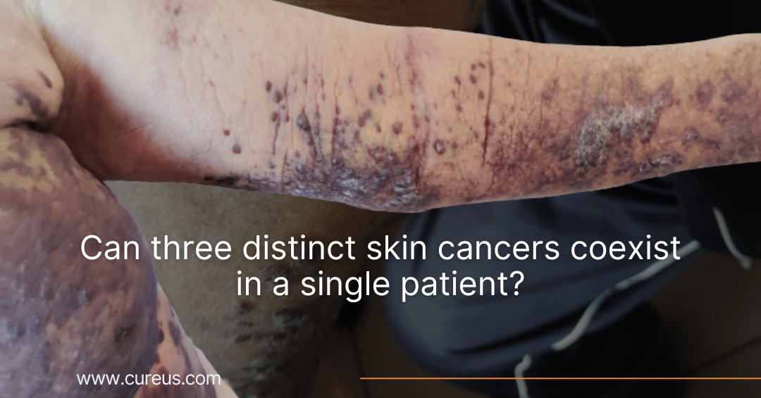 Cureus Dermatology tweet media