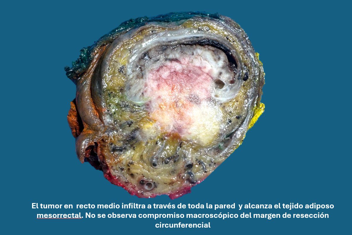lorenaevilla's tweet photo. rectal tumor.
The circumferential resection margin (CRM) — 8 mm in this case — is essential for evaluating local tumor spread.
Margins < 1 mm are considered involved and correlate with higher local recurrence risk.
#Pathology #ColorectalCancer #GIpath #pathoupic #pathAward https://t.co/y1Qqef2VOA