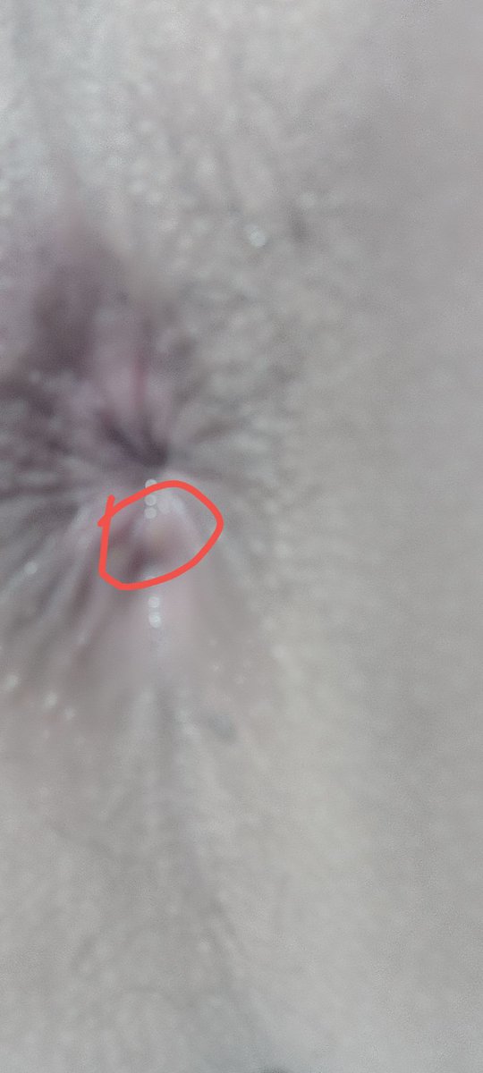 有没有懂的人告诉我为什么钢门后面还有一个小洞，是肛瘘，还是痔疮，还是肛裂