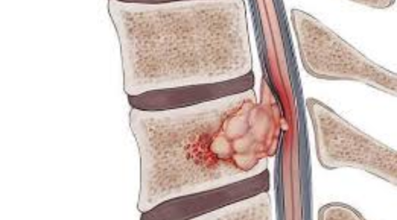 Spine Tumors in Kolkata: Symptoms, Diagnosis and Treatment Options - apsense.com/article/865401…

#SpinalTumors #LeadingSpineNeurosurgeon #SpineTumorKolkata #CureofSpinalTumors