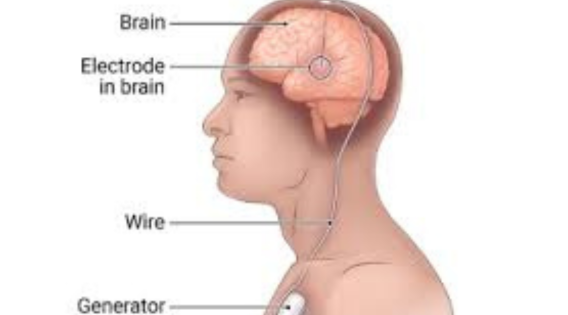 The Science Behind the Brain Pacemaker: Understanding Deep Brain Stimulation apsense.com/article/863408… 

#lifeafterdbs #sucessofdbs #brainpacemaker #canditateofdbs #dbskolkata #dbsforadvancedparkinsonsdisease #leadingdbssurgeon #neurosurgeon #neurosurgery #brainsurgeon #DBS