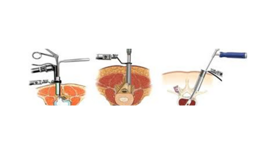 Kolkata's Top Spine Surgeons: Expertise in Minimal Access Spine Surgery for Optimal Results apsense.com/article/862831… 

#MinimallyInvasiveSurgery #MinimalAcessSurgery #spinesurgeon #minimalaccessspine #minimallyinvasivespinesurgery #neurosurgeon #neurosurgery #NeuroCare