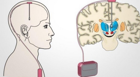 Unlocking Hope: DBS for Advanced Parkinsons Disease in Kolkata - apsense.com/article/860287…

#lifeafterdbs #sucessofdbs #brainpacemaker #canditateofdbs #dbskolkata #dbsforadvancedparkinsonsdisease #leadingdbssurgeon #neurosurgeon #neurosurgery #brainsurgeon #DBS