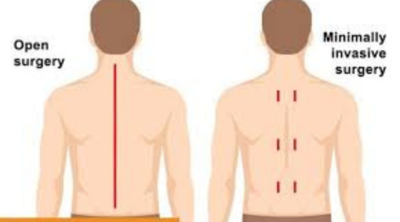 Minimally Invasive Spine Surgery Vs Traditional Open Surgery - apsense.com/article/860599…

#MinimallyInvasiveSurgery #MinimalAcessSurgery #spinesurgeon #minimalaccessspine #minimallyinvasivespinesurgery #neurosurgeon #neurosurgery #NeuroCare