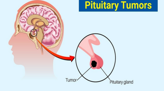Living With a Pituitary Tumor: Managing Symptoms and Finding Support in Kolkata apsense.com/article/858884…

 #pituitarybraintumors #transnasal #pituitarytumor #pituitarytumors #TransnasalSurgery #pituitarybraintumor #VisionRecovery