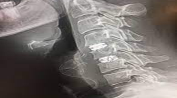 A Guide to Disc Replacement and Cervical Spine Surgery Costs in Kolkata apsense.com/article/857669… 

#CervicalSpineSurgeon #cervicalspineneurosurgeon #cervicalspinesurgery #DiscReplacementSurgery #cervicaldiscreplacement #cervicalspinesurgery