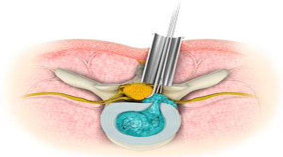 How Minimal Access Spine Surgery in Kolkata Can Improve Spinal Health apsense.com/article/855872…

 #minimallyinvasivesurgery #spinehealth #spinesurgeon #minimalaccessspine #minimallyinvasivespinesurgery #neurosurgeon #neurosurgery