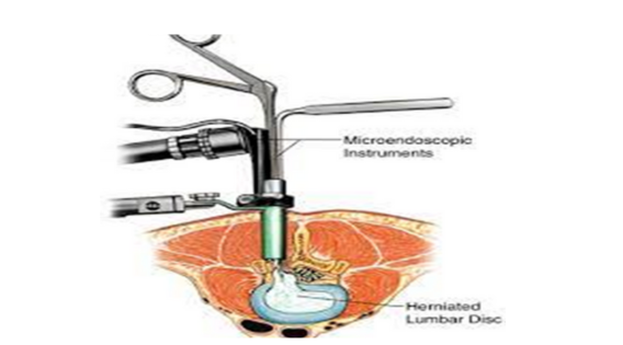 Minimally Invasive Discectomy: A Revolutionary Procedure for Herniated Discs apsense.com/article/854721…

 #minimallyinvasivesurgery #spinehealth #spinesurgeon #minimalaccessspine #minimallyinvasivespinesurgery #neurosurgeon #neurosurgery