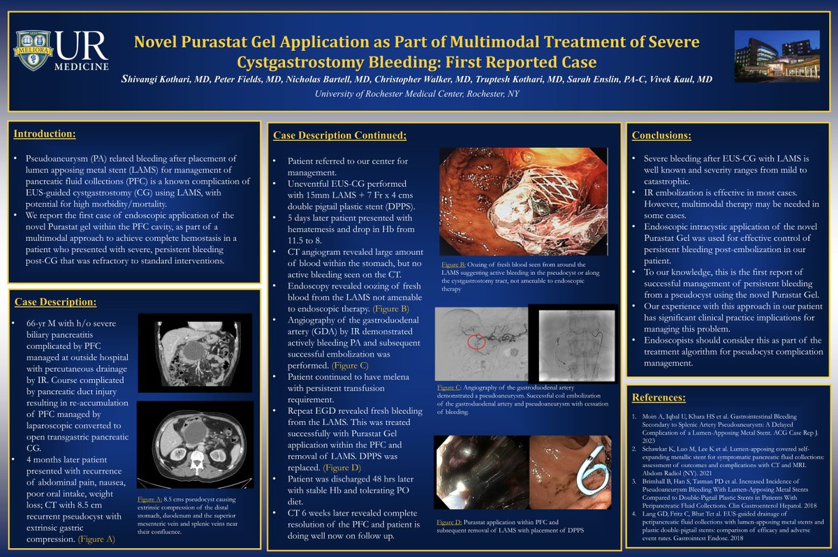 Throwback to ACG 2024:

University of Rochester presented the first reported case of using PuraStat to manage severe post-cystgastrostomy bleeding as part of a multimodal therapy, a breakthrough in endoscopic hemostasis.
We’ll be back at #ACG2025 Booth #566 starting Sunday! #Tbt