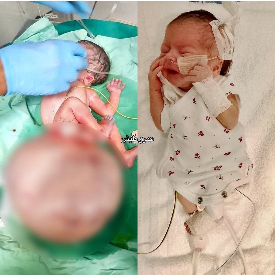 Toleen Sarsour, an 8-month-old premature baby born with severe deformities in the coccyx area caused by complications linked to Israel's genocide in Gaza, underwent a complex but successful four-hour surgery by an Italian medical team to remove a rare tumor.
