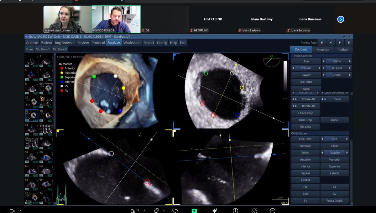 LuchianLuiza's tweet photo. 🙏Honored to serve as discussant in the EACVI TTE & TOE Hands-on Course on interatrial septum imaging
Dr. @papadocardio led an engaging live-guided session—his expertise and clarity made it truly exceptional 👏
#EACVI #echofirst @EACVIPresident @DrGEMandoli #EACVIHIT @escardio https://t.co/UuwPgDerOO