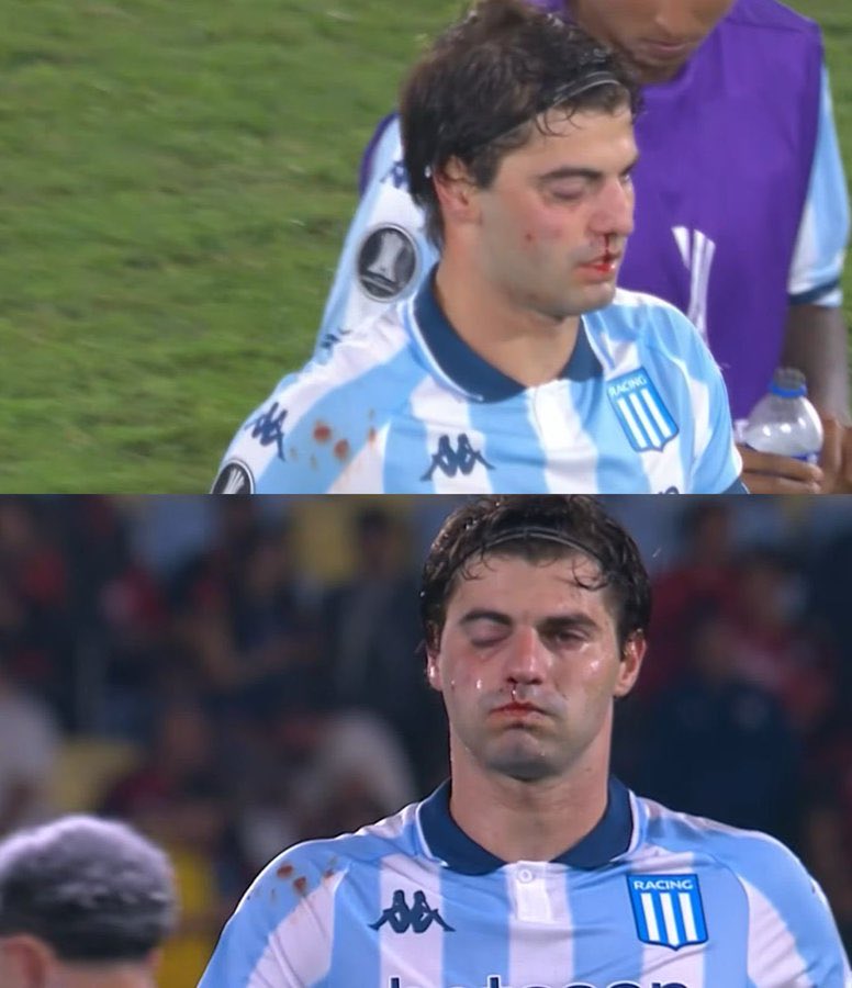 FRACTURA en el maxilar derecho y Santi Sosa siguió jugando. 
Qué capitán tiene Racing