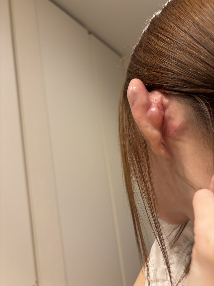 耳フィラーリタッチ行ったら当日の夜中から急に痛み出して耳が奇形になってました😭
これって治るのかな？
抗生剤は服用してるんだけど明日までの分しかない、、、
誰かどうしたらいいか知りませんか？😭
これはどうなってる状態なんだろう、、