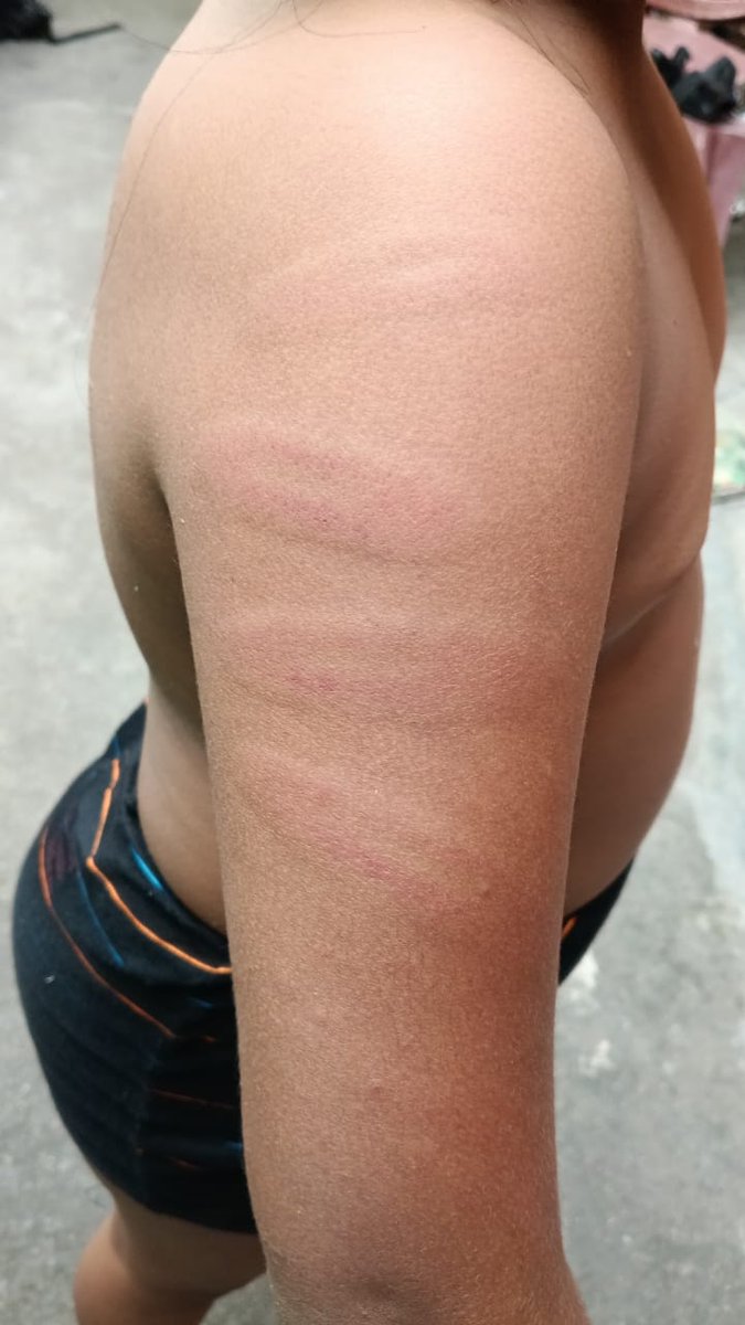 TheBluePen25's tweet image. TW: Child abuse 
#Chennai 
#Dalit
#DMK
சென்னை புழுதிவாக்கம் பகுதியில் உள்ள சென்னை தொடக்கப்பள்ளியில் ஐந்தாம் வகுப்பு படிக்கும் பட்டியல் சமூகத்தைச் சேர்ந்த சிறுமியை தரையில் இங்க் கொட்டியதற்காக Mop Stick கொண்டு அந்த தொடக்கப்பள்ளியின் தலைமை ஆசிரியை இந்திராகாந்தி கொலை வெறி தாக்குதலை…