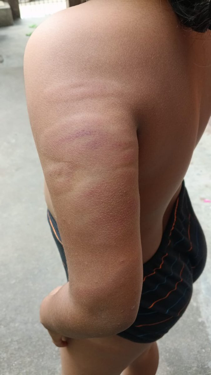 TheBluePen25's tweet image. TW: Child abuse 
#Chennai 
#Dalit
#DMK
சென்னை புழுதிவாக்கம் பகுதியில் உள்ள சென்னை தொடக்கப்பள்ளியில் ஐந்தாம் வகுப்பு படிக்கும் பட்டியல் சமூகத்தைச் சேர்ந்த சிறுமியை தரையில் இங்க் கொட்டியதற்காக Mop Stick கொண்டு அந்த தொடக்கப்பள்ளியின் தலைமை ஆசிரியை இந்திராகாந்தி கொலை வெறி தாக்குதலை…