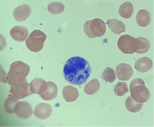 Inpatient Heme Consult: Young pt, limited medical care prior.  some DIC labs positive - rectal bleeding from ulcerative lesion.  Systemic adenopathy suspicious for lymphoma.  LDH very high.  HIV prelim positive.  You see this on smear - diagnosis?