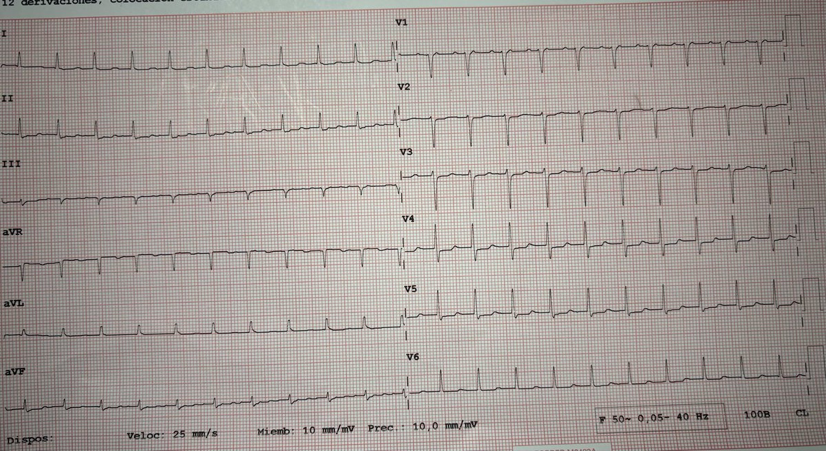 josecruz2102's tweet photo. -Male 50 y/o, palpitations.
-Maculino 50 años, palpitaciones
#Cardiology #EPees #ECG #arrhythmias #rhythm #cardiologia
✅Dx? Probably localization?
Opinions? @adribaran @SergioPinski @Arron_Pearce_ https://t.co/gU44NOL0gI