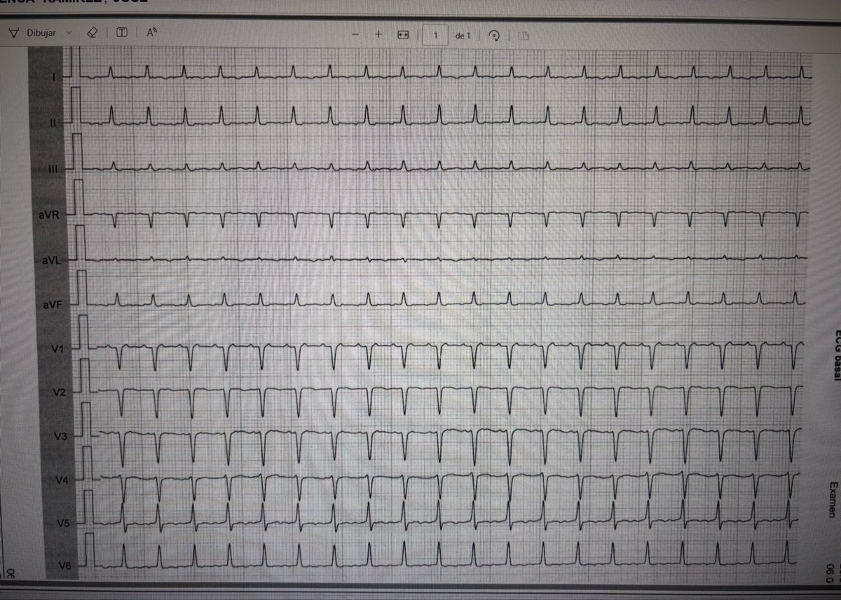 josecruz2102's tweet photo. -Male 50 y/o, palpitations.
-Maculino 50 años, palpitaciones
#Cardiology #EPees #ECG #arrhythmias #rhythm #cardiologia
✅Dx? Probably localization?
Opinions? @adribaran @SergioPinski @Arron_Pearce_ https://t.co/gU44NOL0gI