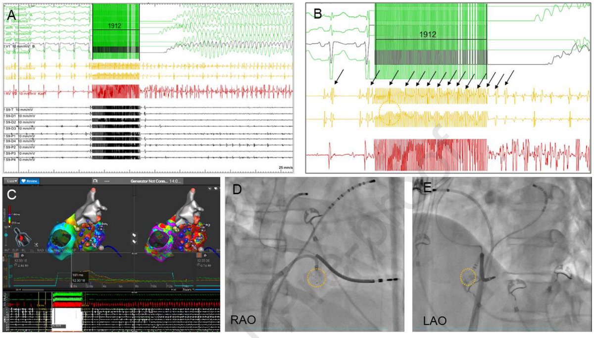 Boldizsar Kovacs (@boldikovacsmd) on Twitter photo ⚡VF during RF ablation near <a href="/BIOTRONIK_News/">BIOTRONIK News</a> ICD coils with <a href="/Medtronic/">Medtronic</a> #Sphere9⚡️
In 2 cases, RF‼️delivery close to the RV coil reproducibly triggered VF with visible pectoral contractions, no direct lead contact or malfunction.
📄:doi.org/10.1016/j.hrth…
#EPeeps #VTablation ⚡VF during RF ablation near <a href="/BIOTRONIK_News/">BIOTRONIK News</a> ICD coils with <a href="/Medtronic/">Medtronic</a> #Sphere9⚡️
In 2 cases, RF‼️delivery close to the RV coil reproducibly triggered VF with visible pectoral contractions, no direct lead contact or malfunction.
📄:doi.org/10.1016/j.hrth…
#EPeeps #VTablation