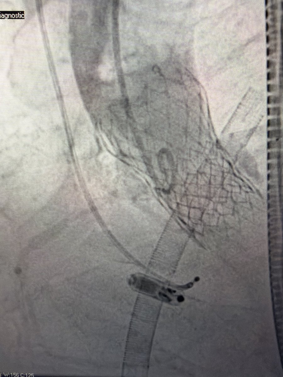 g_giustinoMD's tweet photo. Double UNICORN LAVA-ECMO supported with bilateral coronary high obstruction risk. Both leaflet traversed and lacerated from single RFA access with 22 DrySeal. S3 23 mm implanted and final preserved coronary flow.

Rock stable on LAVA with wide open AR and preserved pulsatility

Doing great POD1