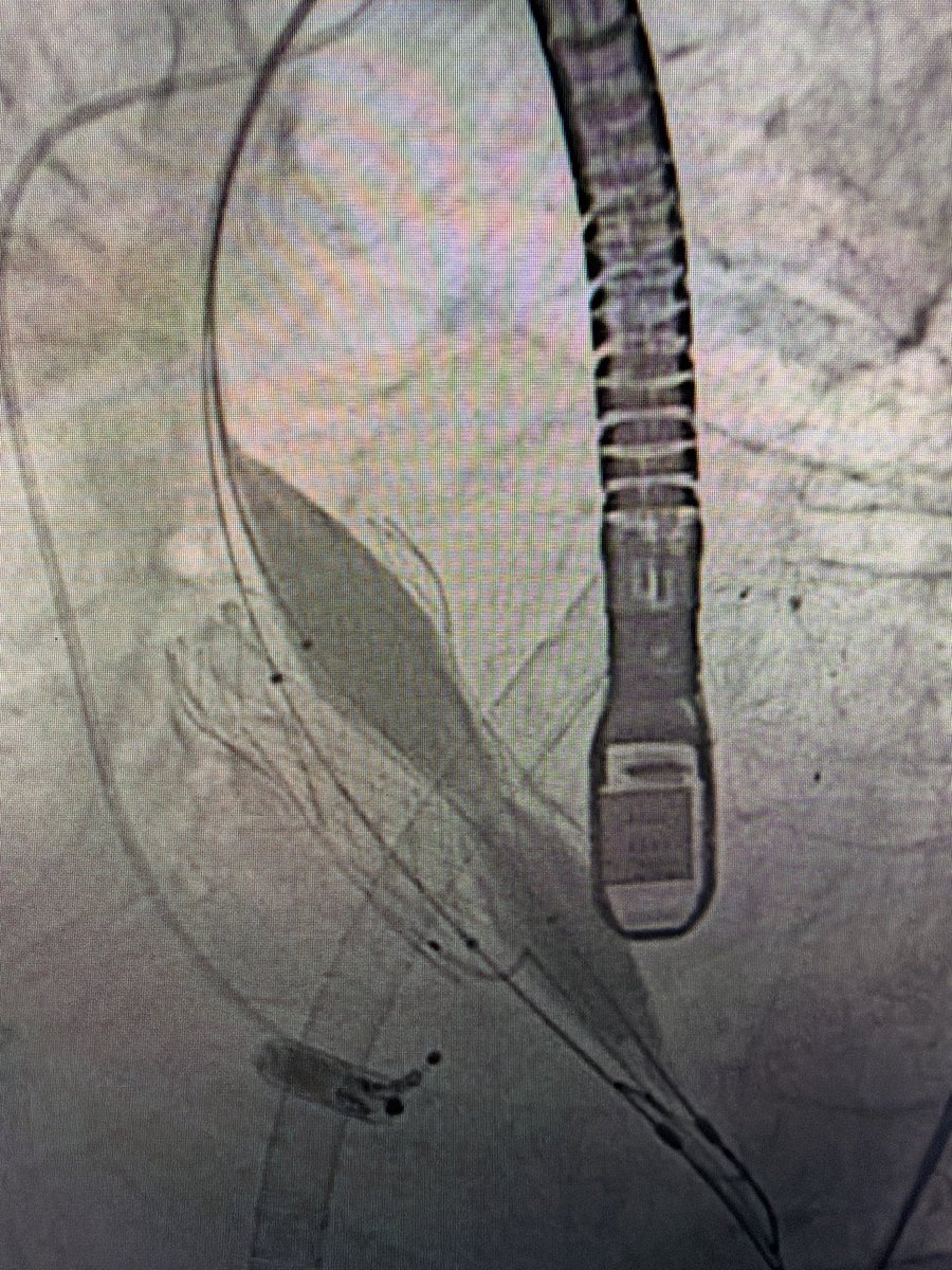 g_giustinoMD's tweet photo. Double UNICORN LAVA-ECMO supported with bilateral coronary high obstruction risk. Both leaflet traversed and lacerated from single RFA access with 22 DrySeal. S3 23 mm implanted and final preserved coronary flow.

Rock stable on LAVA with wide open AR and preserved pulsatility

Doing great POD1