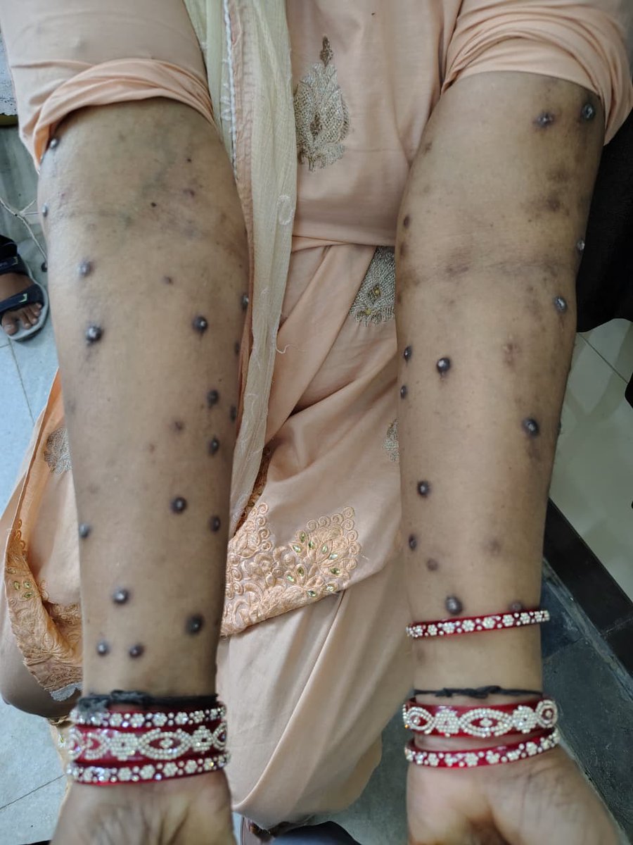 Diagnosis...??
<a href="/ArunInamadar/">Arun C Inamadar MD , FRCP (Edin), FRCP(London)</a> 
<a href="/Doctors_GUILD/">MEDICINE MADNESS</a> 
<a href="/Doctors__squad/">Dr Honey choudhary 🩺</a> 
<a href="/IhabFathiSulima/">Dr Ihab Suliman</a>