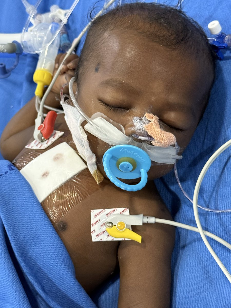 Day 4&amp;5: Healing Little Hearts 💕 Liv’s legacy 🐙 camp 4, Karimnagar, India 🇮🇳🫶 5 open heart surgeries performed in 2days along with several out patient consultations. More children and urgent cases are still turning up at out patient clinic. <a href="/HLHcharity/">HealingLittleHearts</a>