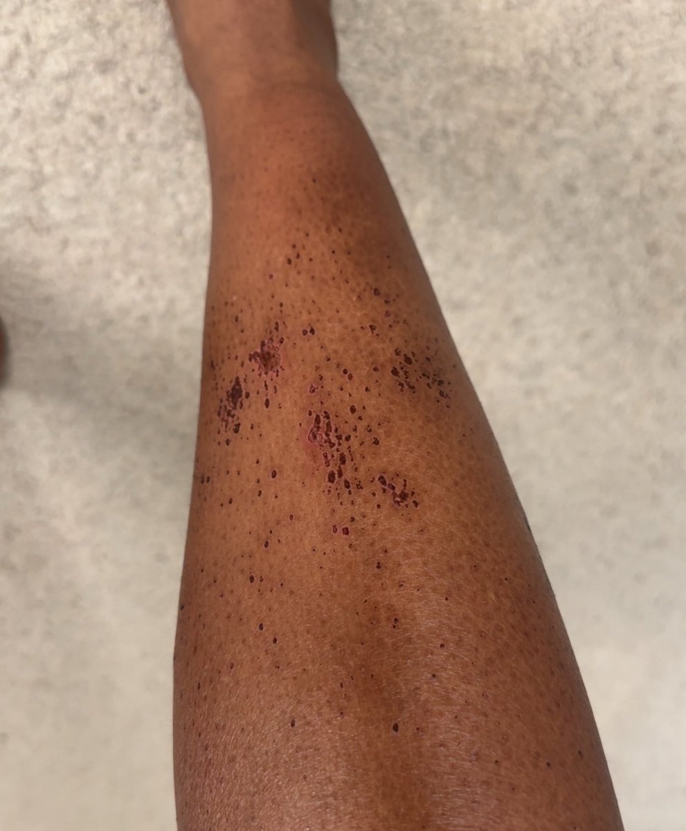 sabsrobinson's tweet photo. The nail salon slaughtered my legs with some harsh ass scrub so now I gotta heal it with my products. https://t.co/PfiImvRo2H