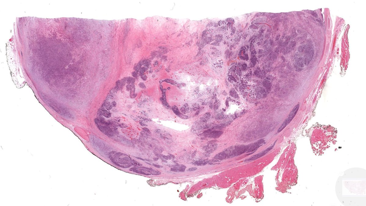 JMGardnerMD's tweet image. 20 yo M. Deep intramuscular calf nodule. SOX-10 +. Loss of SMARCB1 staining.
Answer ✅ youtu.be/YrUty8brYHU?si…
Digital slides: kikoxp.com/posts/21930
#pathology #pathologists #pathTwitter #dermpath #dermatology #dermatologia #dermtwitter #BSTpath