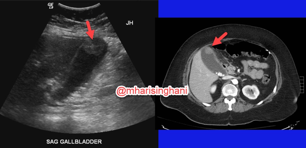 mharisinghani's tweet photo. Adenocarcinoma of GB arising in polyp https://t.co/ZZebfSRYb7