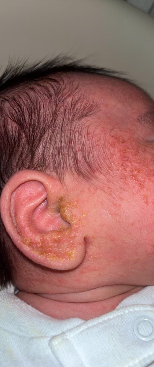 رضيع مصاب ب Impetiginized atopic dermatitis 

(التهاب الجلد التأتبي (الإكزيما) المصاب بالقوباء)
(إلتهاب جلد بكتيري)

الصورة من الإنترنت*

لاحظ قشور عسلية اللون الواضحة

علاجها مضاد حيوي كريم، وترطيب إلخ..

يجب تنظيف القشور بالماء الدافئ عن طريق قطن دافئ مبلل لتليينها قبل المضاد.