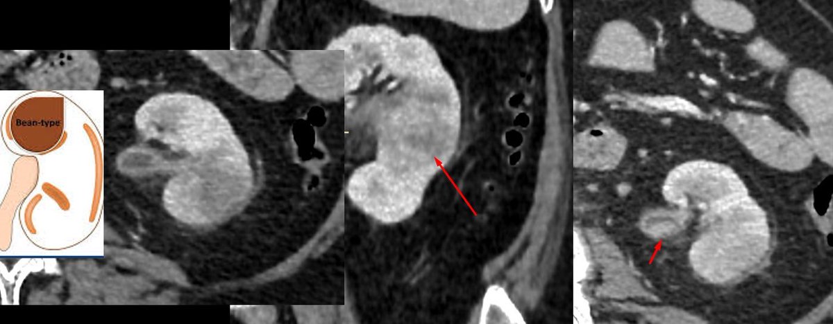 sofia_gambetta's tweet photo. @danatsouza Cool case and great example of a ball-type lesion! In contrast, we had a bean-type one this week with ureteral involvement ⏩everything points to transitional cell carcinoma. 
(Case from @fedediaztelli) https://t.co/OX7wqTsZYW